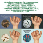 Tratamiento Anti hongo para las uñas NAIL FUNGUS – Prevención y Alivio Rápido AHORA2x1