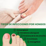 Tratamiento Anti hongo para las uñas NAIL FUNGUS – Prevención y Alivio Rápido AHORA2x1